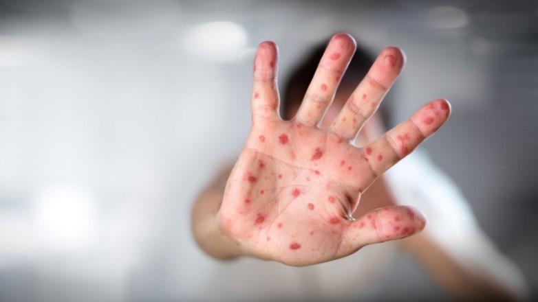 Medidas preventivas contra el sarampión