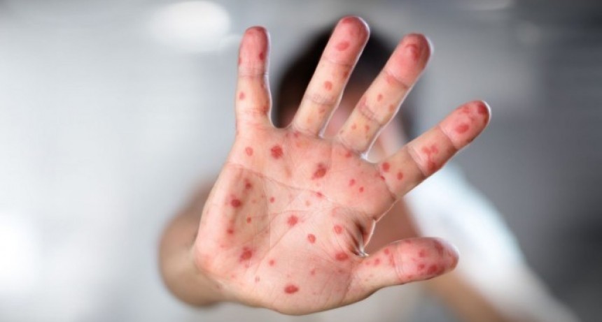 Medidas preventivas contra el sarampión