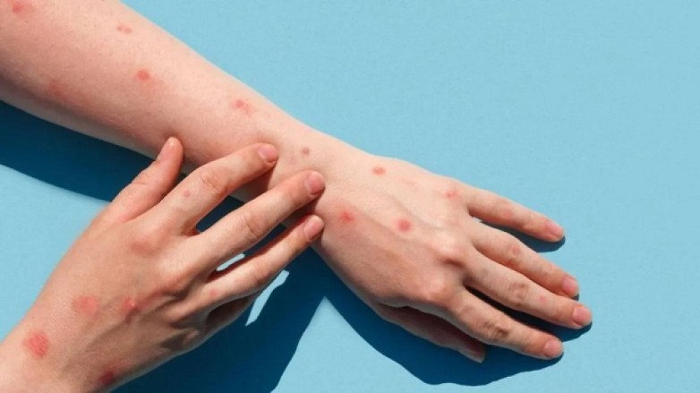 Qu&eacute; es la mpox y cu&aacute;les son las medidas para prevenir la enfermedad