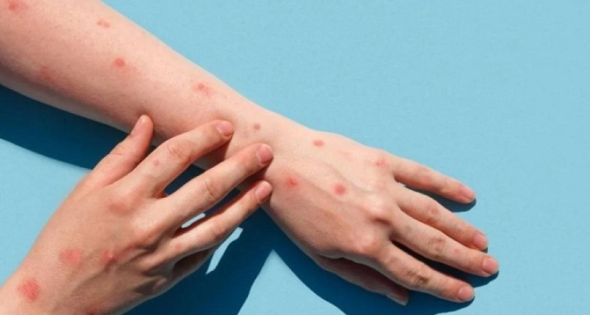 Qu&eacute; es la mpox y cu&aacute;les son las medidas para prevenir la enfermedad
