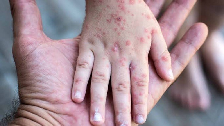 Alerta por Sarampi&oacute;n: c&oacute;mo es el esquema de vacunaci&oacute;n obligatoria y qu&eacute; s&iacute;ntomas controlar